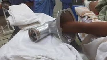 Un niño metió la mano en una maquina de moler carne y pasó algo muy grave