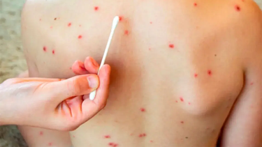 En San Juan queda uno de los casos sospechosos de sarampión que aún no fue descartado.