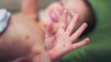 Alerta sarampion: en San Juan insisten con la vacunación