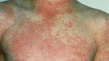 Temor en una escuela iglesiana: 30 casos de varicela y escarlatina