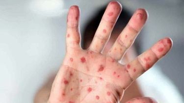 La viruela del mono sigue sumando infectados en todo el mundo