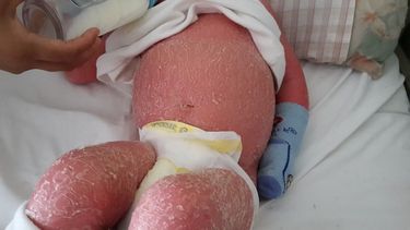 Santino tiene una enfermedad en la piel y necesita ayuda para viajar al Garraham