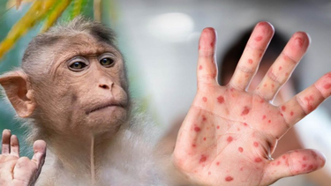 La viruela del mono genera una gran preocupación en la OMS.