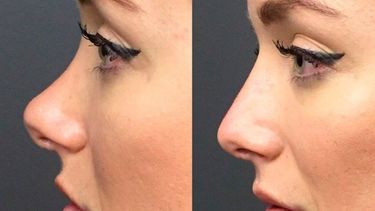 Cambiar nuestra nariz sin pasar por un quirófano