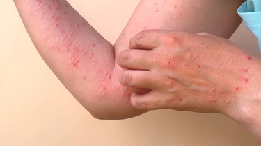 Alerta mundial: cómo se contagia la viruela del mono y cuáles son sus síntomas