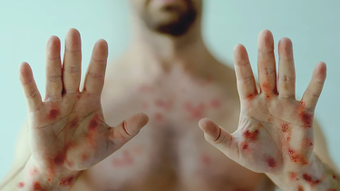 Detectaron el primer caso de la viruela del mono más grave en un paciente argentino sin atencendente de viaje. Se trata de un hombre de 31 años. &nbsp;