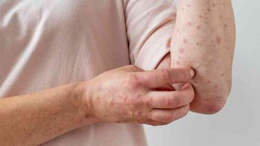 La viruela del mono sigue sumando casos en todo el mundo