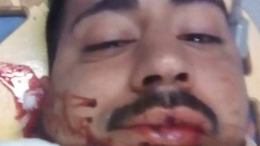 Sufrió un accidente, terminó con la mandíbula fracturada y no lo pueden operar