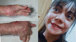 La sanjuanina con piel de cristal que necesita 45 mil dólares para operarse y nada más tiene un año para juntarlos