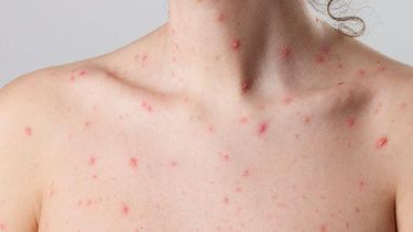 La OMS pide aumentar las medidas preventivas ante el avance de la&nbsp;viruela del mono