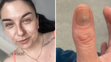 El increíble diagnóstico que le dieron a una mujer por una fina mancha en un dedo.