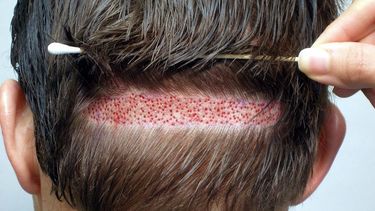 Implante capilar, una tendencia que crece cada vez más en hombres y mujeres de San Juan