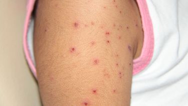 Para Epidemiología no existe situación de alarma por casos de varicela