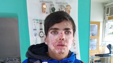 Vuelven a pedir ayuda para el joven con Piel de Cristal