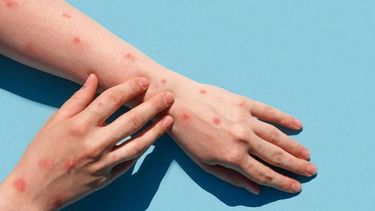 Qué es la viruela del mono y cómo se transmite