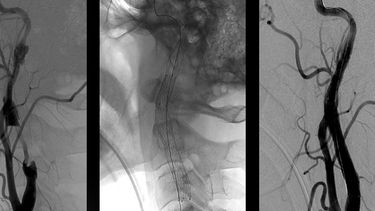 En un rápido operativo, mirá cómo salvaron la vida de un joven accidentado de 16 años
