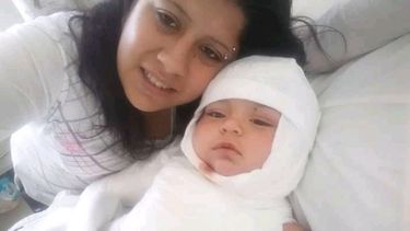 El bebé caucetero quemado con agua hirviendo mejora día a día