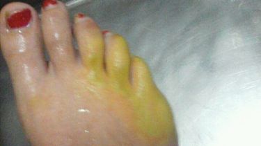 Tremendo: jugaba en la escuela y se quemó las piernas con ácido