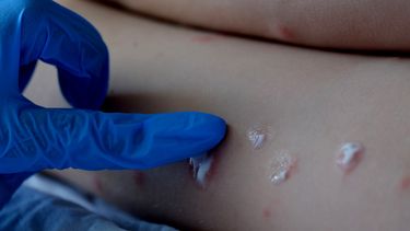 La viruela del mono empieza a preocupar a las autoridades sanitarias de Nueva York