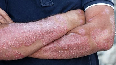 Inauguraron un consultorio para la psoriasis en el Hospital Rawson