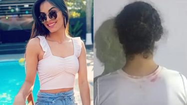 Una mujer desfiguró a la ex de su pareja tirándole soda cáustica en la cara