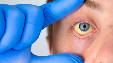 Alerta sanitaria por la enfermedad zoonótica: qué es, cuáles son los síntomas y cómo se contagia