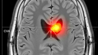 Los cinco síntomas que podrían indicar un ACV y nunca deben subestimarse, según un neurólogo