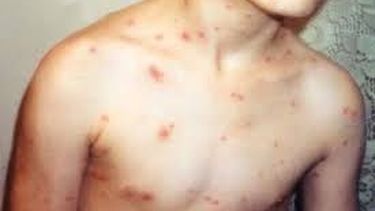 Preocupación porque 1 de cada 3 niños no se vacunó contra la varicela