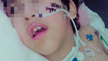 Analizan entregar un subsidio extraordinario a una niña con hidrocefalia y parálisis cerebral