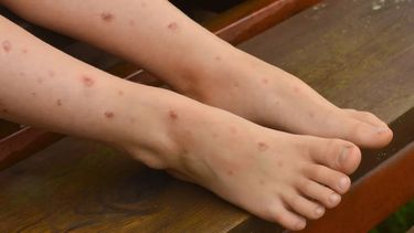 La gripe del tomate presenta síntomas parecidos al Covid 19