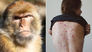 Viruela del mono: infectóloga sanjuanina detalla los síntomas y cómo evitar el contagio