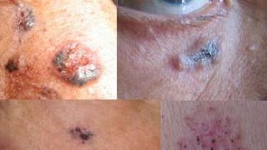 Atenderán gratis las consultas por lesiones de piel sospechosas