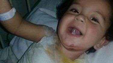 El cauceterito que se quemó con agua hirviendo se recupera pero su familia necesita ayuda