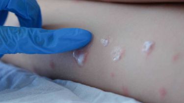 La viruela del mono mantiene en vilo a la Organización Mundial de la Salud