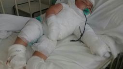 A un bebé de Caucete le cayó agua hirviendo y quedó hospitalizado con serias quemaduras