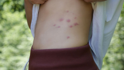 Terror mundial: ¿qué es la fiebre Oropouche?