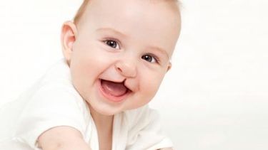 Convocan a pacientes con labio leporino