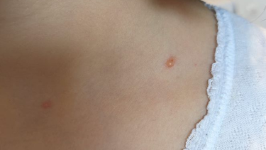 Los casos de varicela en preadolescentes y adolescentes de San Juan llamaron la atención en las últimas semanas. Qué se debe tener en cuenta. (Imagen ilustrativa)