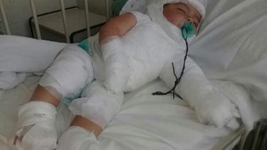 ¿Cómo sigue el bebé caucetero que le cayó agua hirviendo en su cabeza?