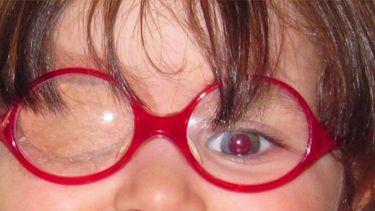 Una pequeña sanjuanina perdió sus lentes especiales y la madre, desesperada, pide ayuda